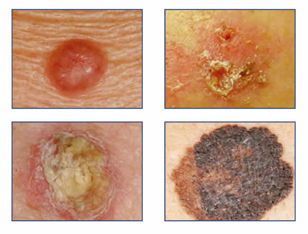 Melanoma cáncer de piel