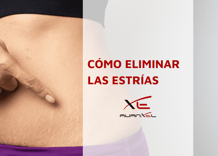 Cómo eliminar las estrías