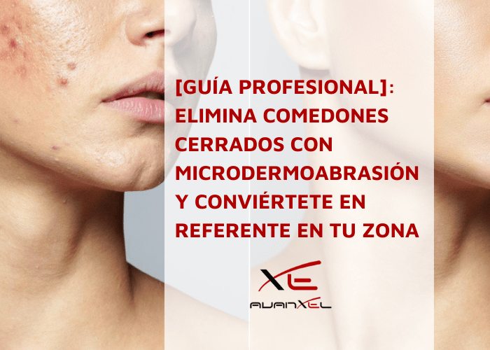 Comedones cerrados: elimínalos con microdermoabrasión