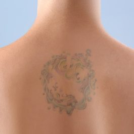 Foto Terapia Eliminar tatuajes