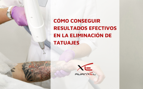 Cómo conseguir resultados efectivos en la eliminación de tatuajes